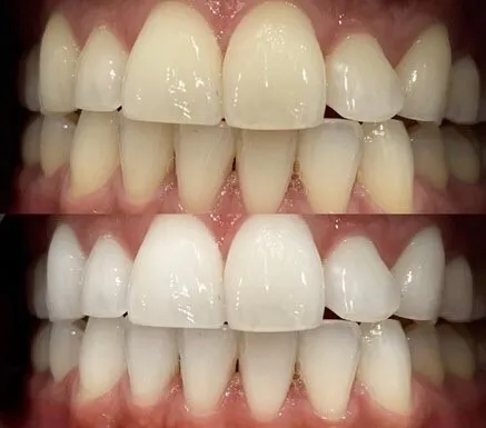 歯の美しさにこだわるなら、医療提携ホワイトニングの施術がおすすめ