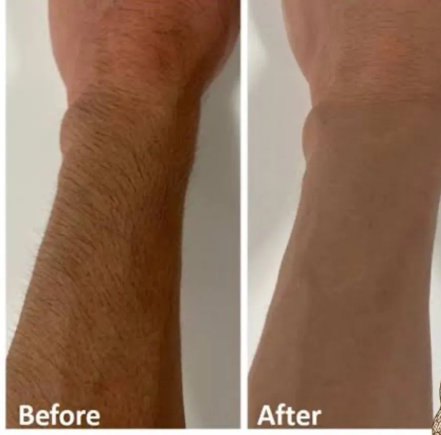 腕脱毛7回目のお客様Before/after