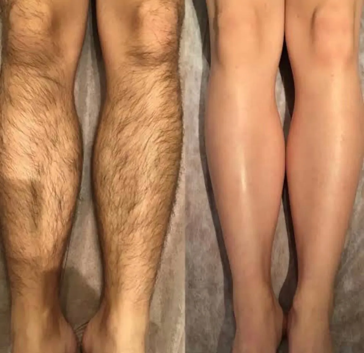 学生限定！膝下脱毛が3000円