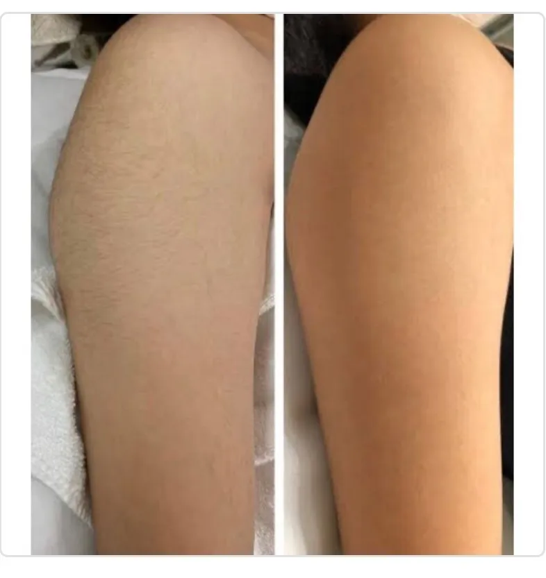 夏前からの脱毛がおすすめ！