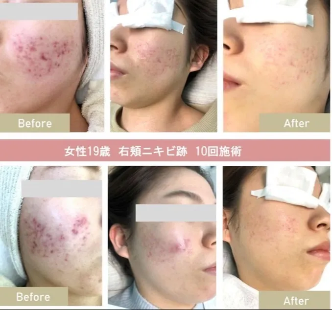 フォトフェイシャルで美肌実現