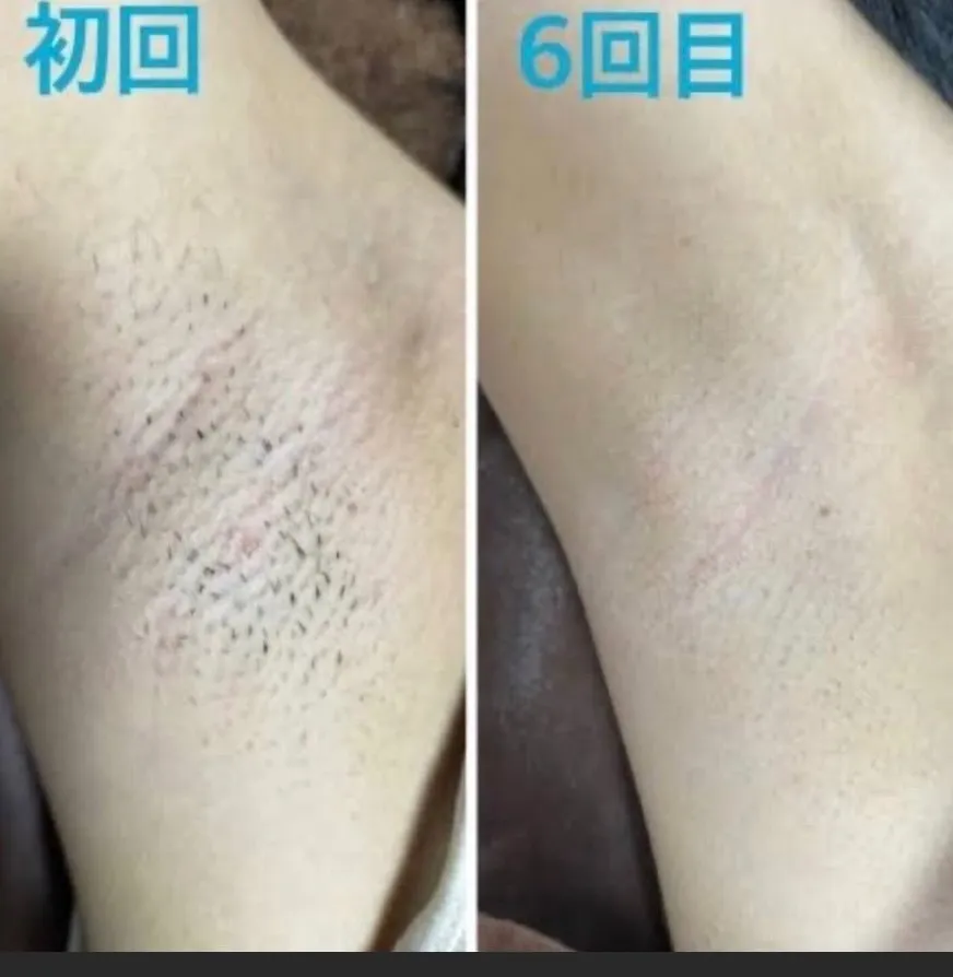 脇脱毛６回目のお客様