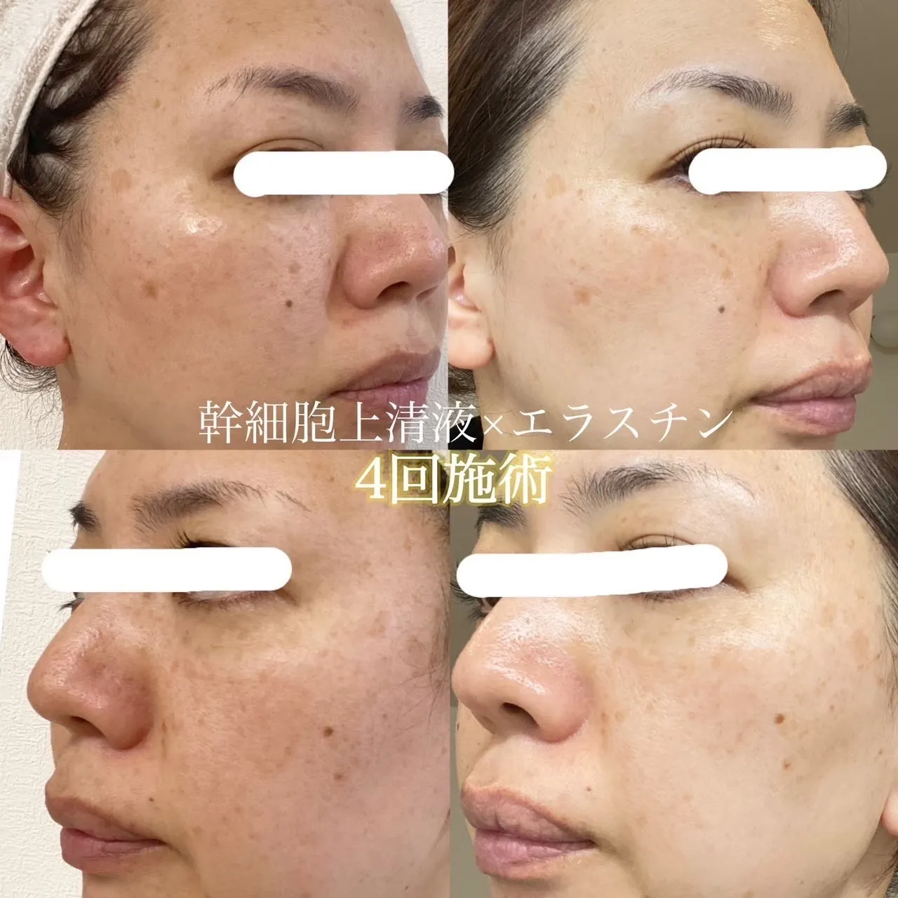 水光ジェット４回目のお客様Before/afterです！