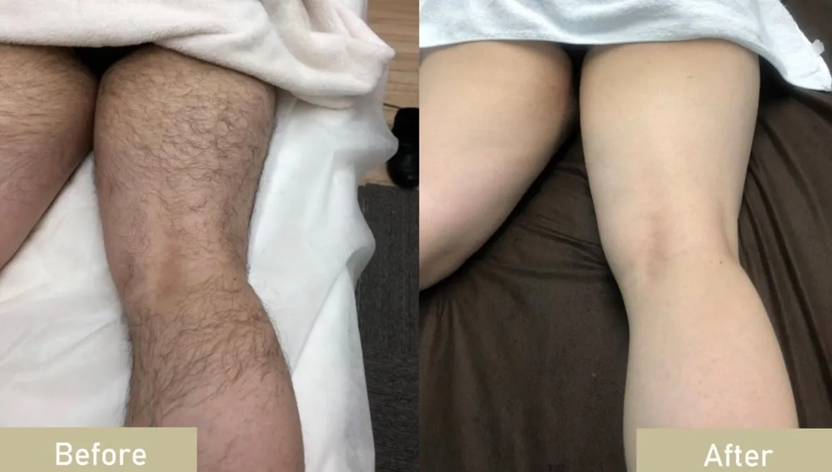 脱毛8回目のお客様before/after お写真です！
