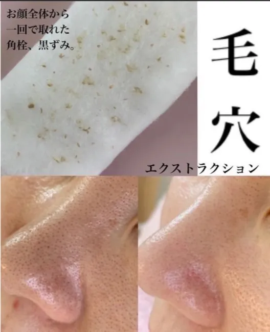 黒ずみ解消！毛穴ケア方法