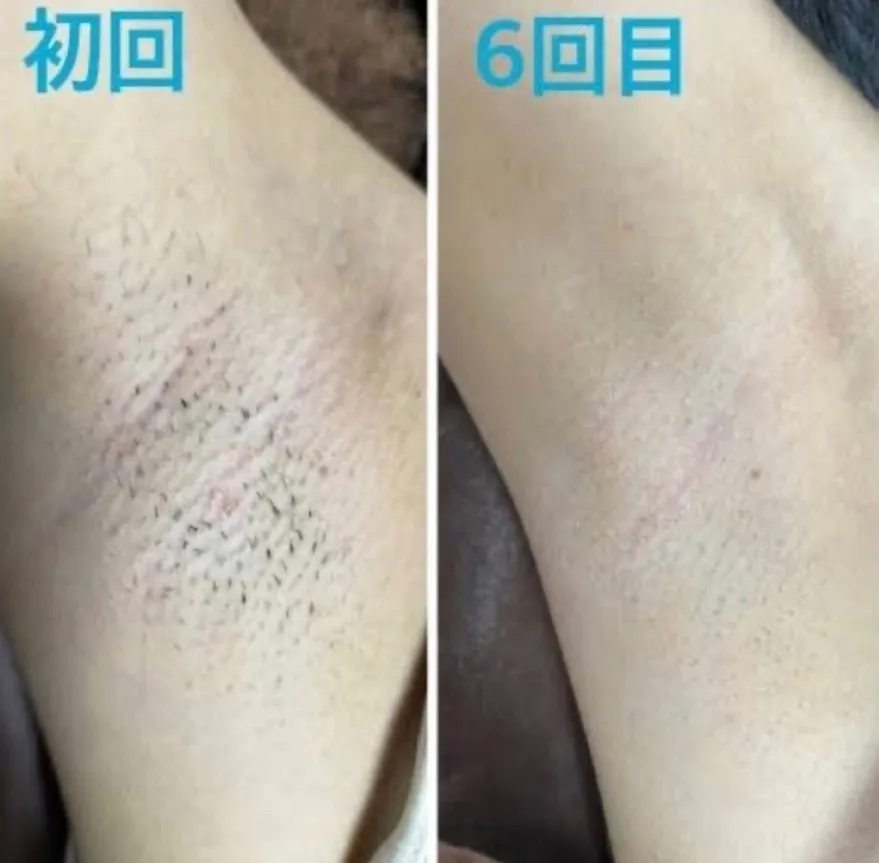 脇脱毛 6回目のお客様