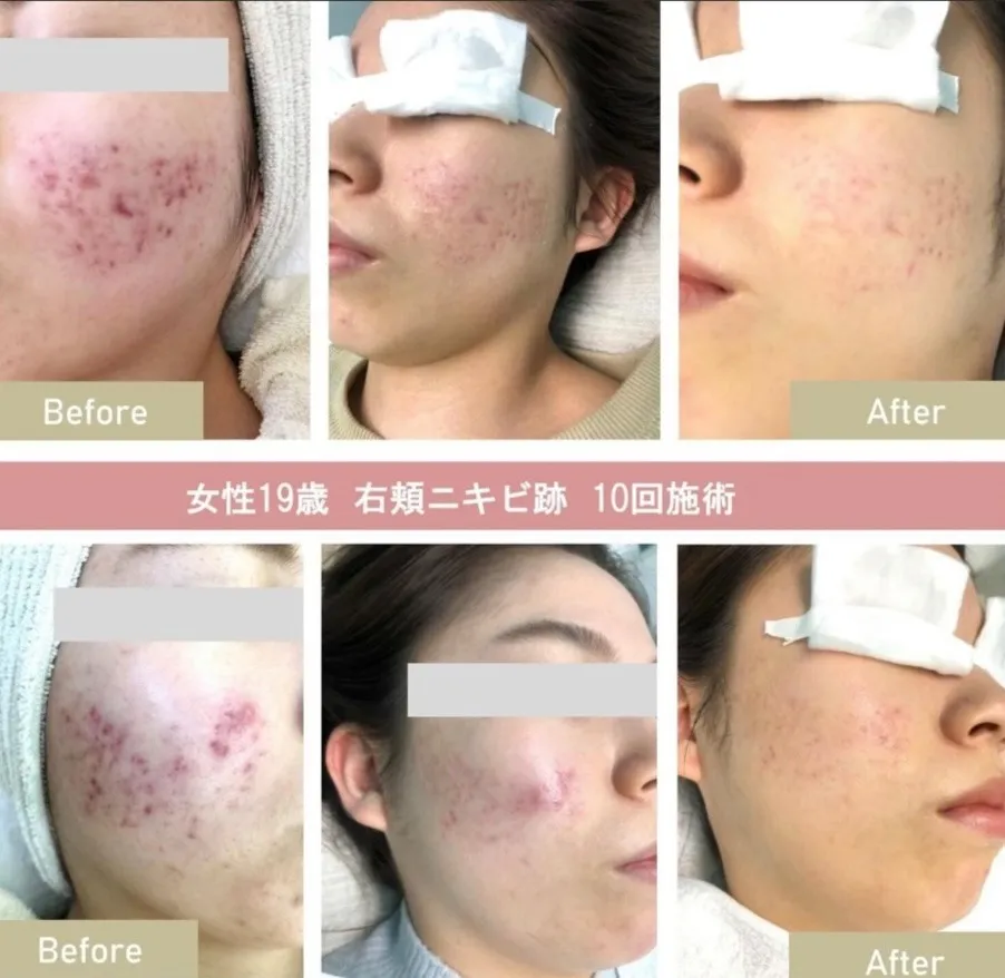 フォトフェイシャル効果で肌トーンアップ