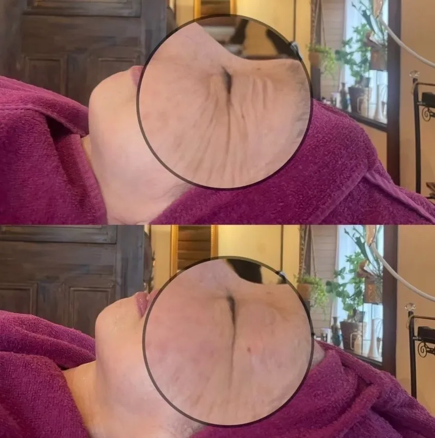 水光ジェット8回目のお客様   before/after お写真になります！