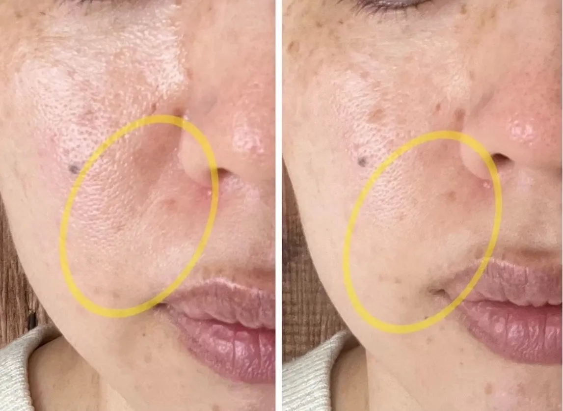 幹細胞導入水光ジェット1回目のお客様 before/after お写真になります！