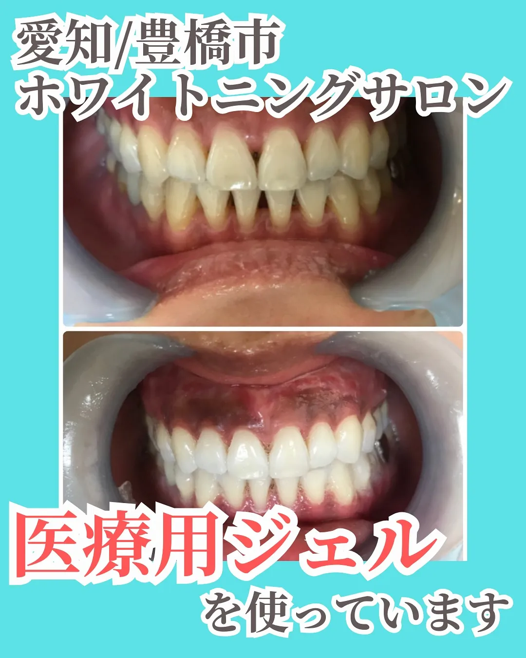 🦷【写真でわかるビフォーアフター】