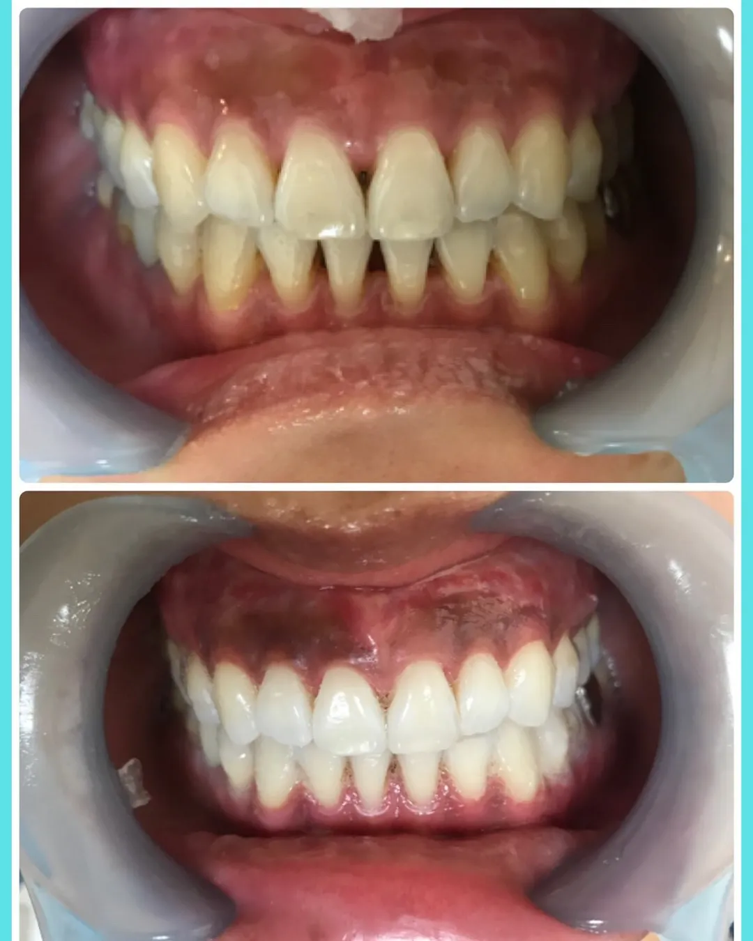 🦷【写真でわかるビフォーアフター】
