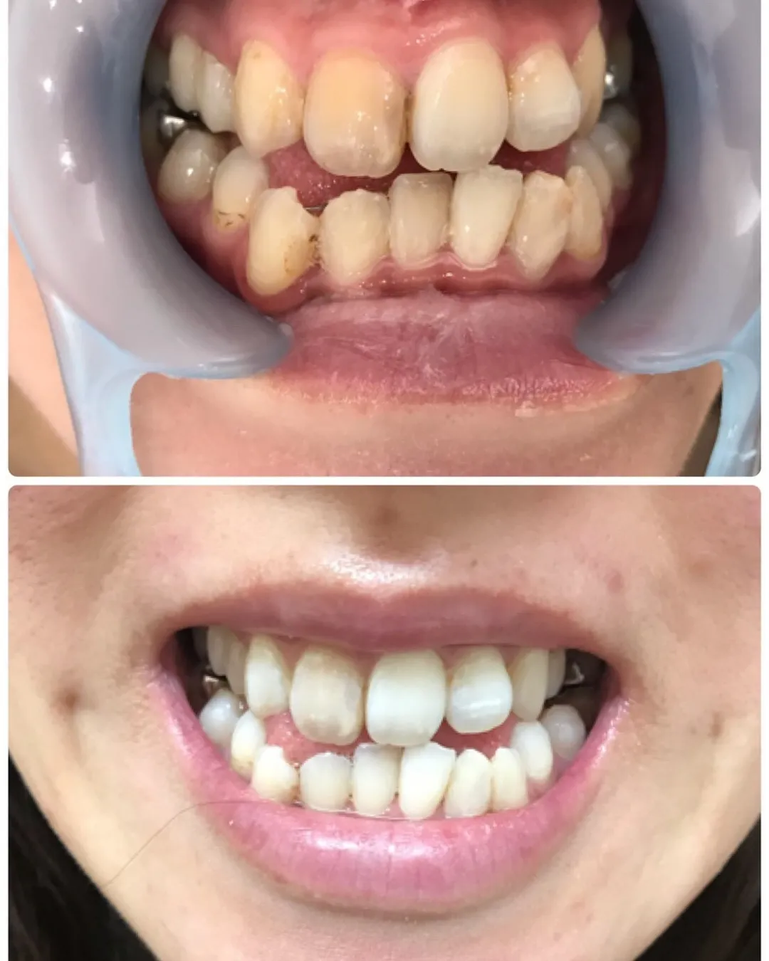 🦷【写真でわかるビフォーアフター】